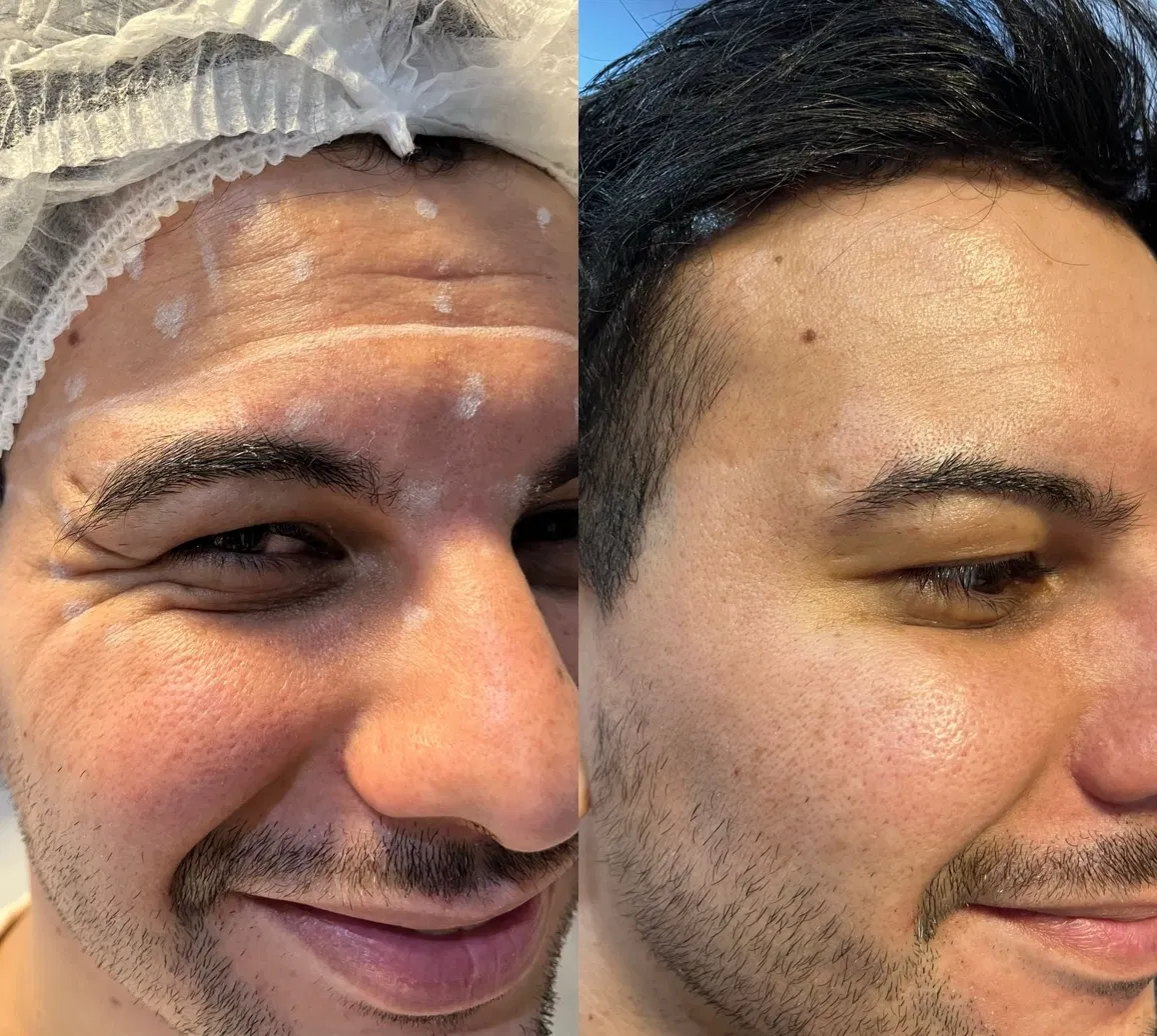 Antes e depois de tratamento facial masculino com melhora de linhas perioculares.