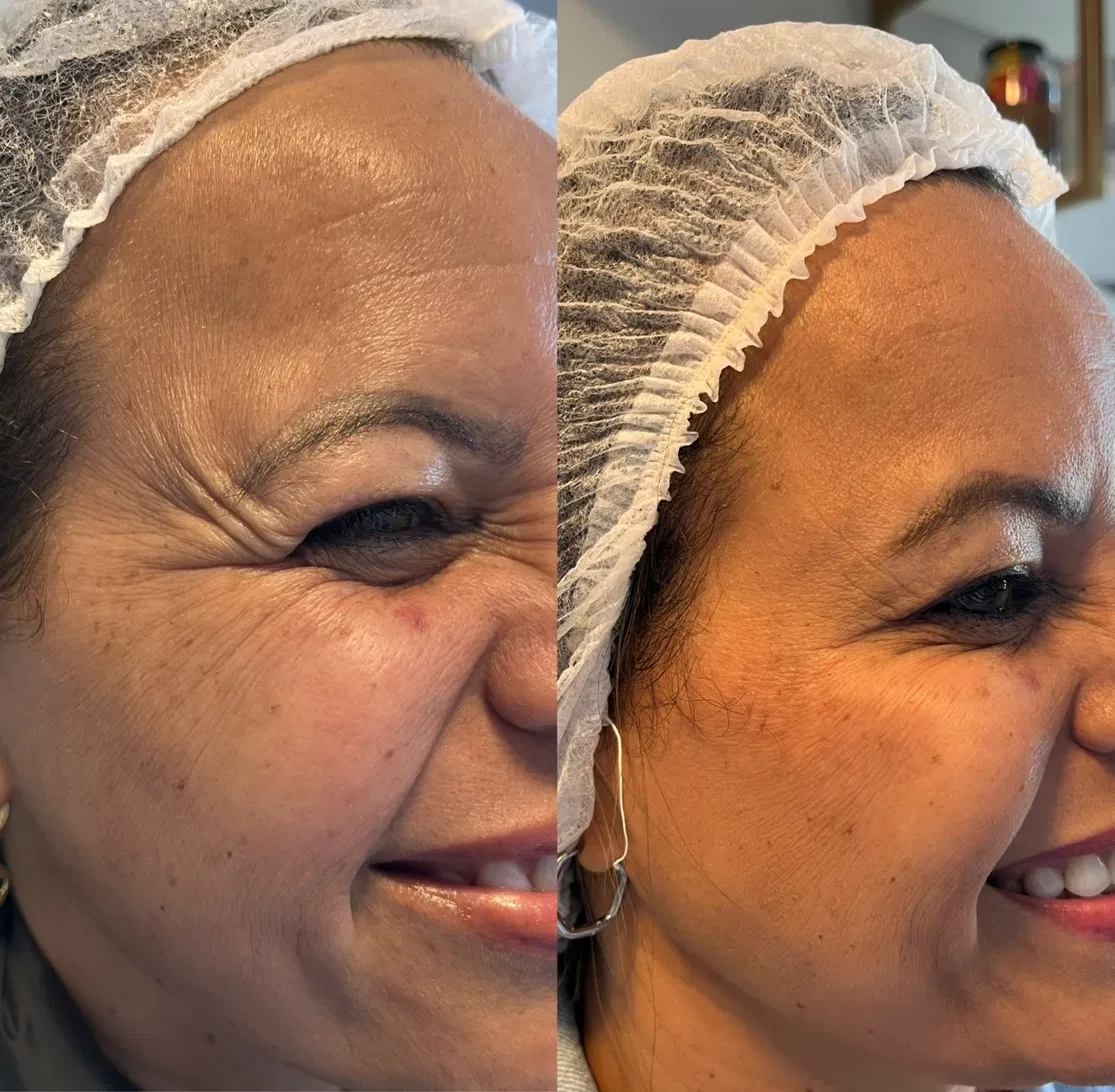 Antes e depois com suavização de rugas ao redor dos olhos em paciente sorrindo.